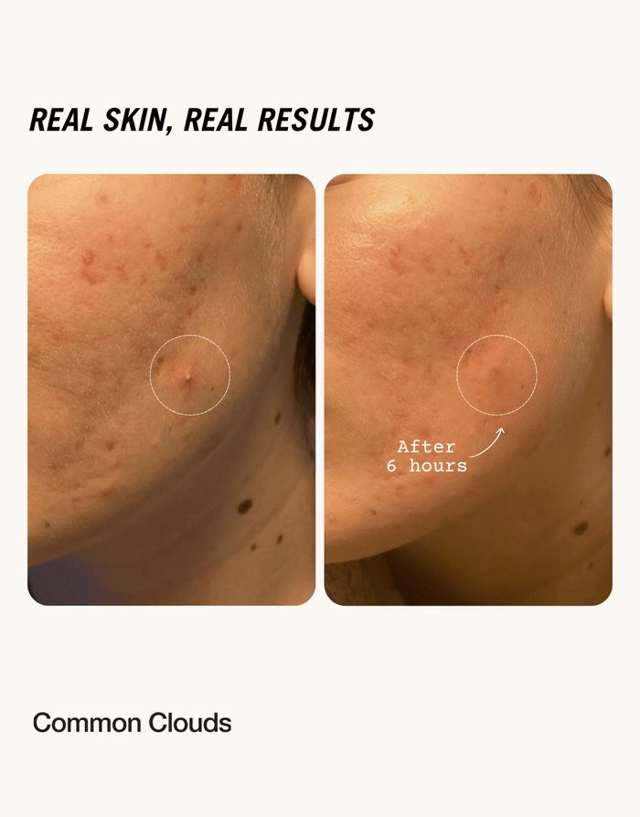 Before and after pictures showing the results of how a cloud shaped pimple patch from Common Clouds works.